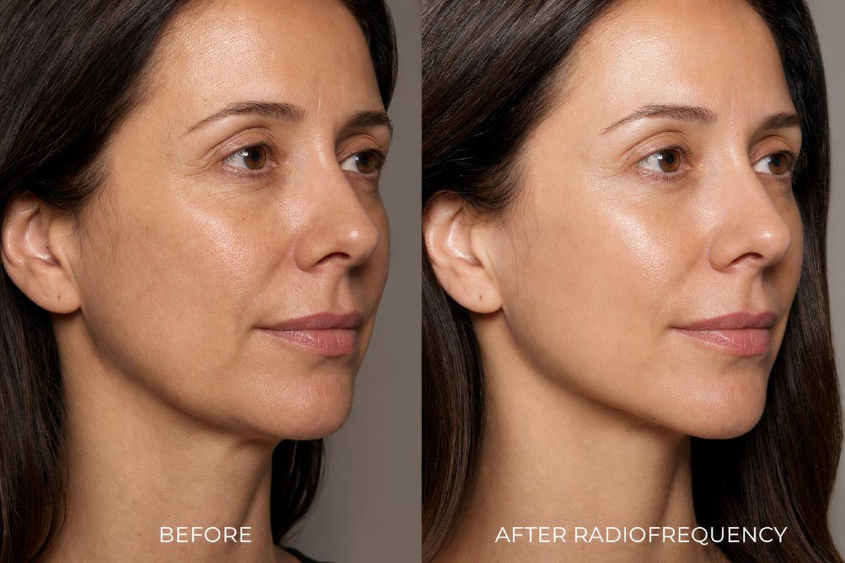 Radiofrecuencia Facial Avanzada